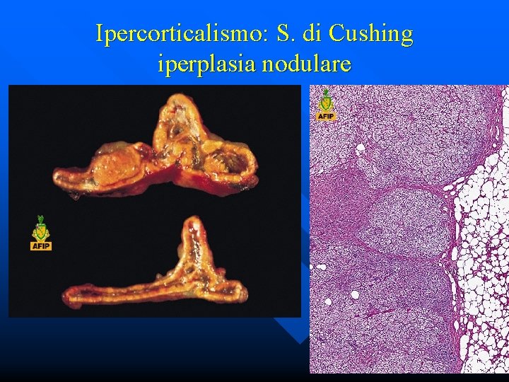 Ipercorticalismo: S. di Cushing iperplasia nodulare 