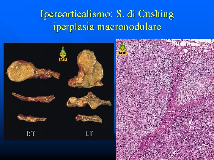 Ipercorticalismo: S. di Cushing iperplasia macronodulare 