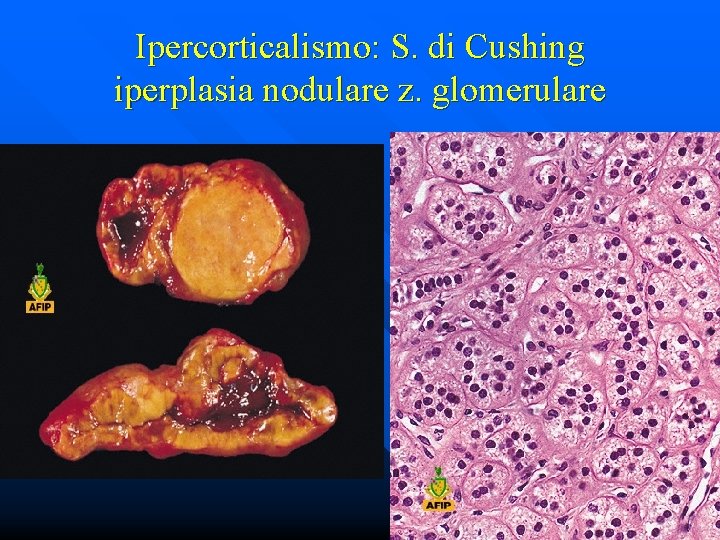 Ipercorticalismo: S. di Cushing iperplasia nodulare z. glomerulare 