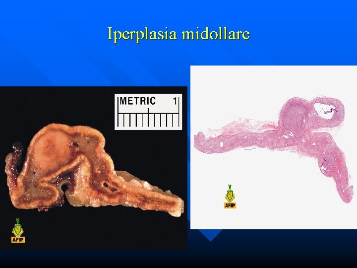 Iperplasia midollare 