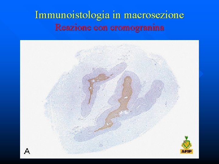 Immunoistologia in macrosezione Reazione con cromogranina 