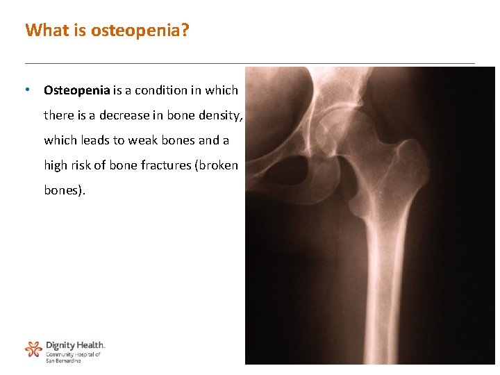 What is osteopenia? • Osteopenia is a condition in which there is a decrease