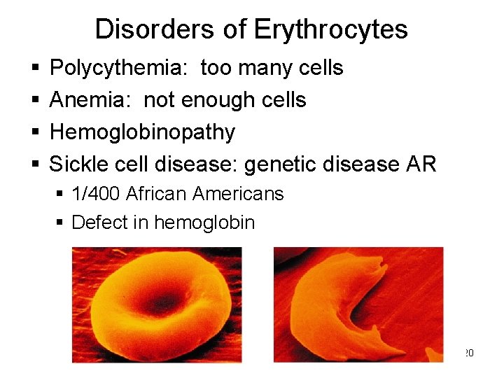 Disorders of Erythrocytes Polycythemia: too many cells Anemia: not enough cells Hemoglobinopathy Sickle cell