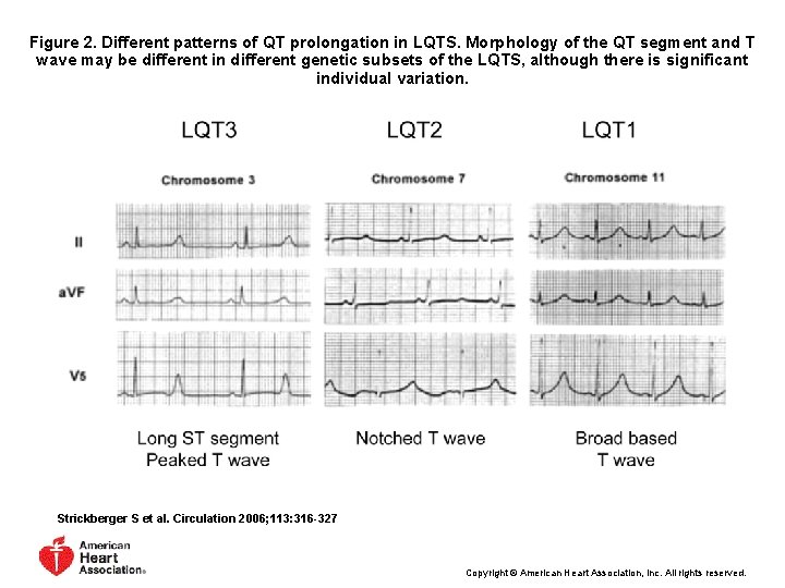Figure 2. Different patterns of QT prolongation in LQTS. Morphology of the QT segment