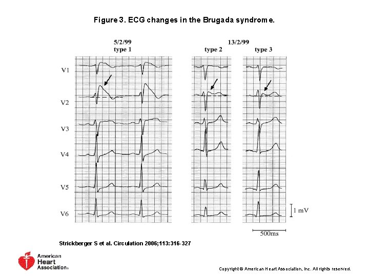 Figure 3. ECG changes in the Brugada syndrome. Strickberger S et al. Circulation 2006;