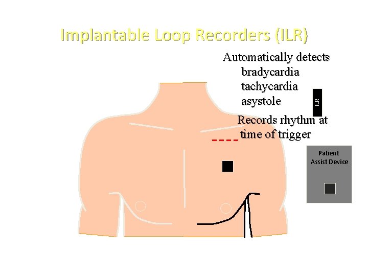 Implantable Loop Recorders (ILR) ILR Automatically detects bradycardia tachycardia asystole Records rhythm at time