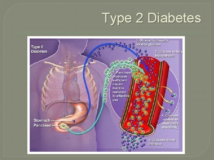 Type 2 Diabetes 