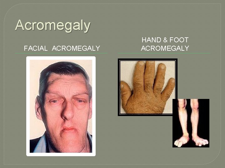 Acromegaly FACIAL ACROMEGALY HAND & FOOT ACROMEGALY 