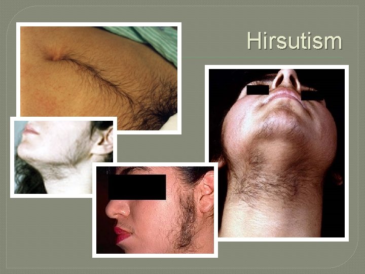 Hirsutism 