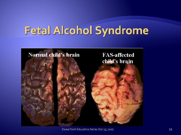 Fetal Alcohol Syndrome Dawn Farm Education Series Oct 25, 2007 21 