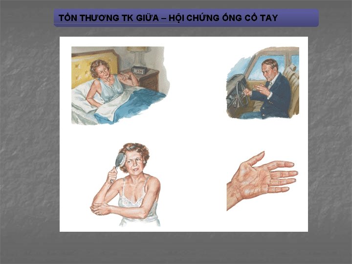 TỔN THƯƠNG TK GIỮA – HỘI CHỨNG ỐNG CỔ TAY 