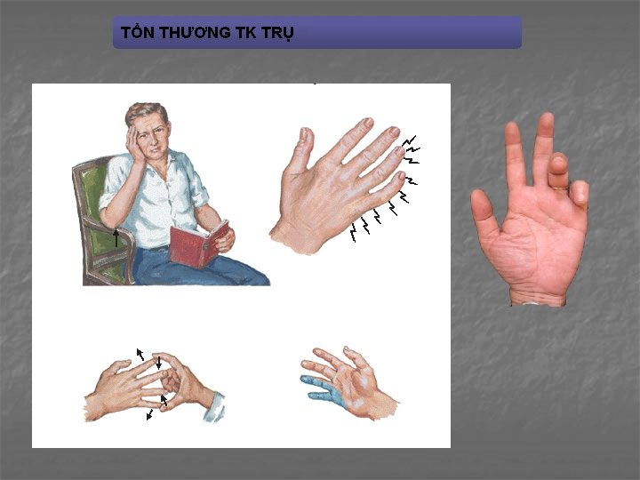 TỔN THƯƠNG TK TRỤ 