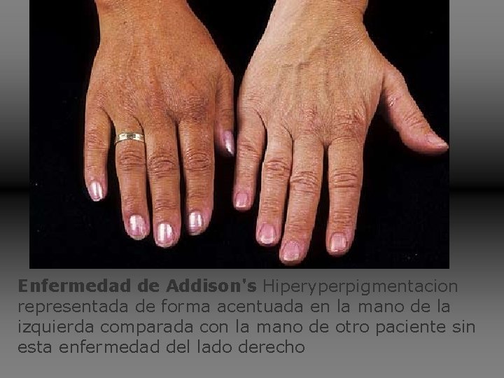 Enfermedad de Addison's Hiperyperpigmentacion representada de forma acentuada en la mano de la izquierda