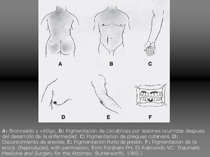 A: Bronceado y vitiligo. B: Pigmentacion de cixcatrices por lesiones ocurridas despues del desarrollo