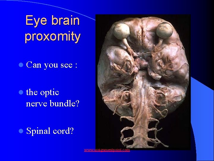 Eye brain proxomity l Can you see : l the optic nerve bundle? l