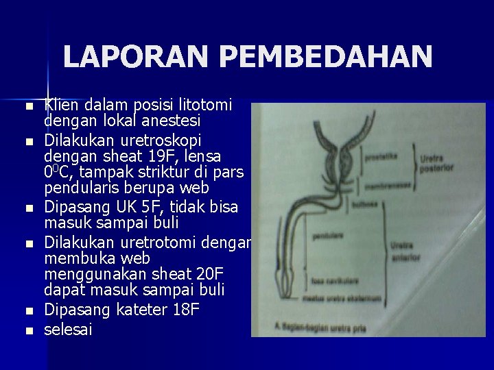 LAPORAN PEMBEDAHAN n n n Klien dalam posisi litotomi dengan lokal anestesi Dilakukan uretroskopi