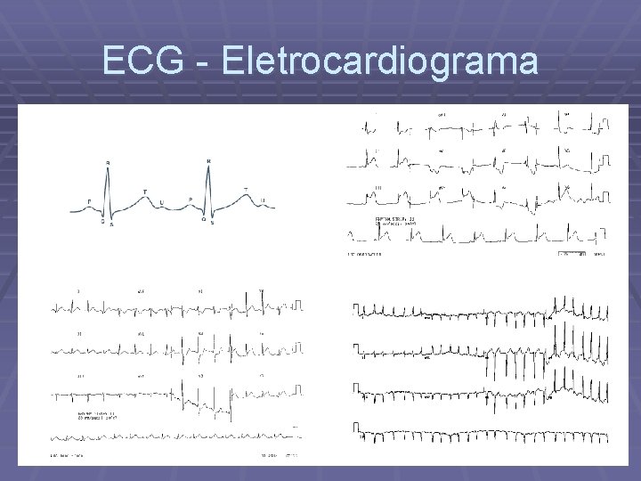 ECG - Eletrocardiograma 