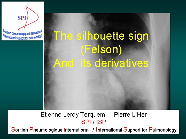 The silhouette sign (Felson) And its derivatives Etienne Leroy Terquem – Pierre L’Her SPI
