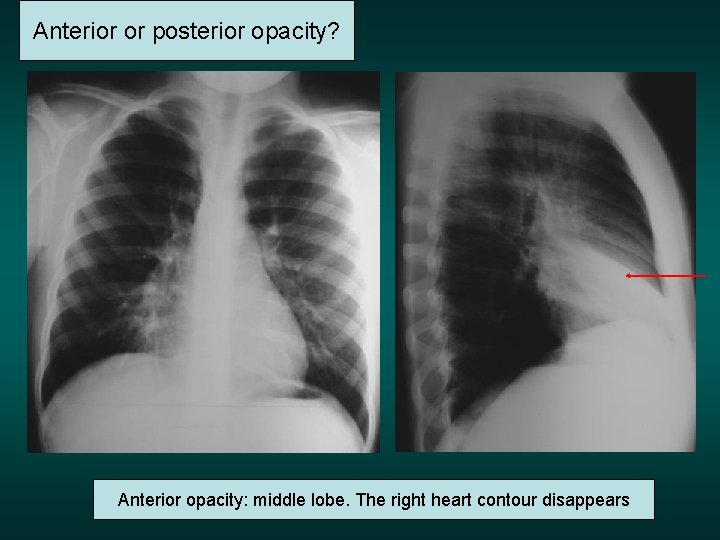 Anterior or posterior opacity? Anterior opacity: middle lobe. The right heart contour disappears 