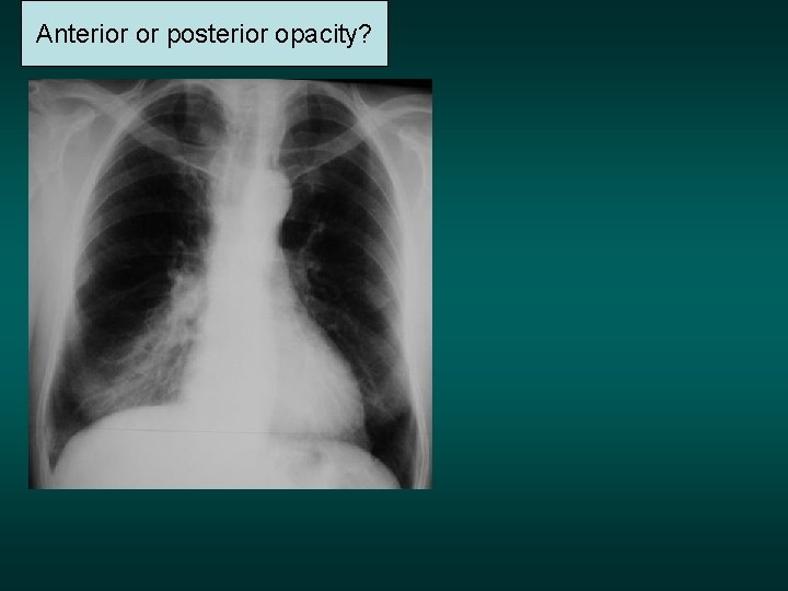 Anterior or posterior opacity? 