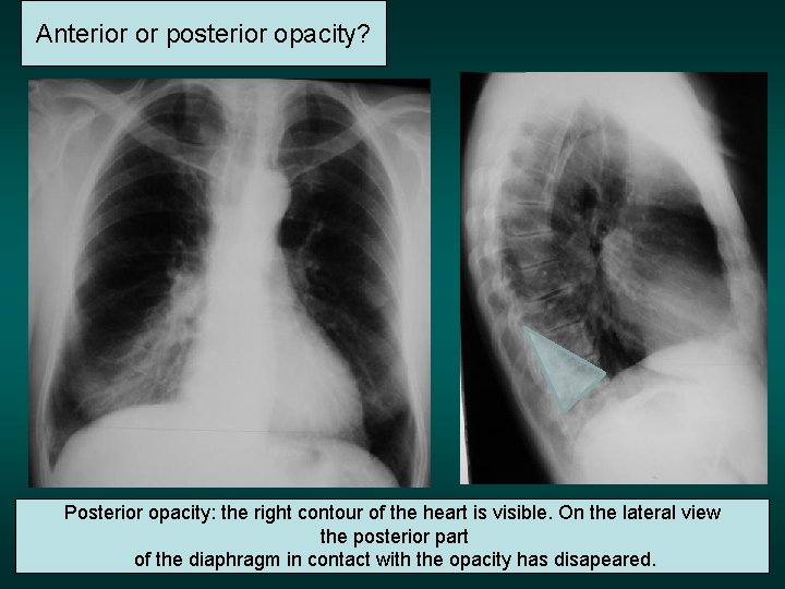 Anterior or posterior opacity? Posterior opacity: the right contour of the heart is visible.