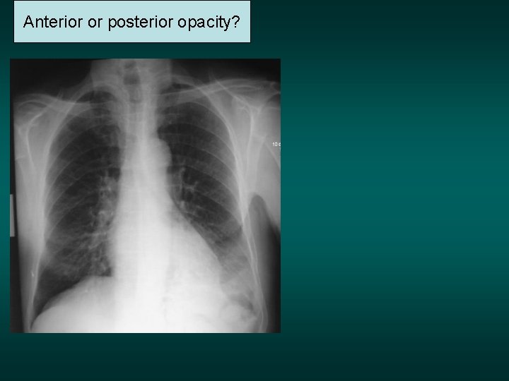 Anterior or posterior opacity? 
