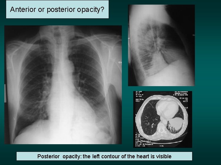 Anterior or posterior opacity? Posterior opacity: the left contour of the heart is visible