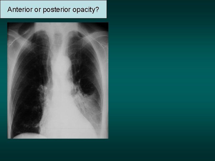 Anterior or posterior opacity? 