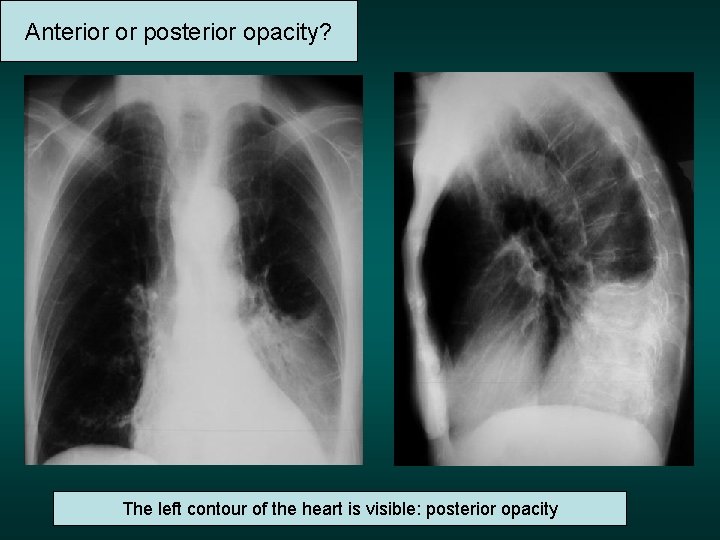 Anterior or posterior opacity? The left contour of the heart is visible: posterior opacity