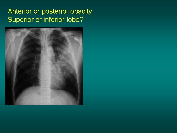 Anterior or posterior opacity Superior or inferior lobe? 