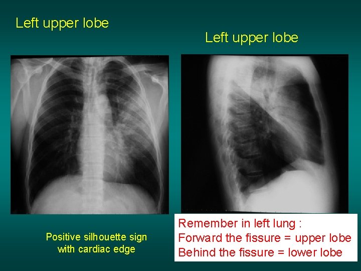 Left upper lobe Positive silhouette sign with cardiac edge Left upper lobe Remember in