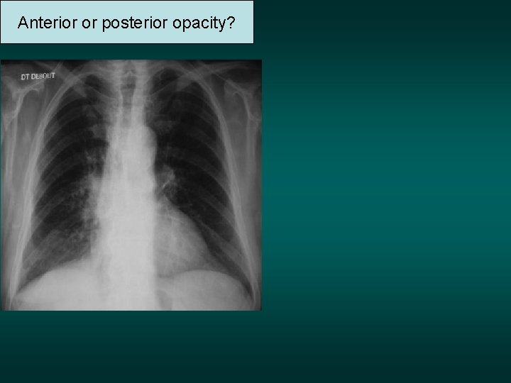 Anterior or posterior opacity? 