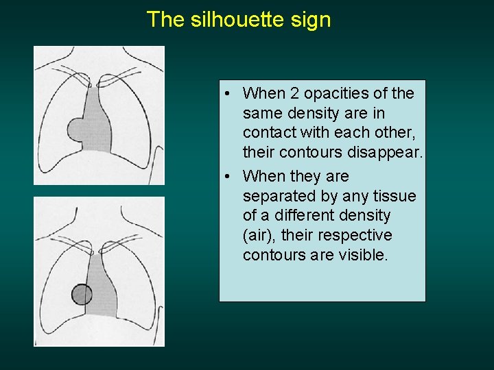 The silhouette sign • When 2 opacities of the same density are in contact