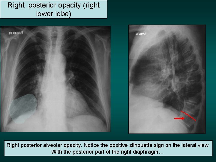 Right posterior opacity (right lower lobe) Right posterior alveolar opacity. Notice the positive silhouette
