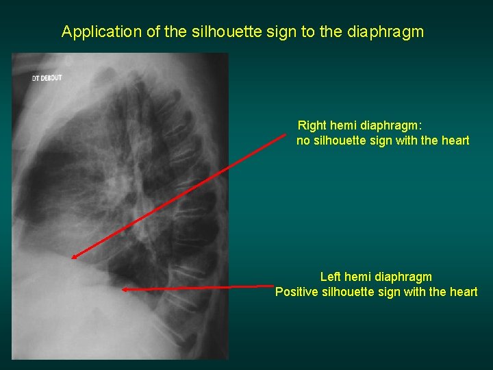 Application of the silhouette sign to the diaphragm Right hemi diaphragm: no silhouette sign