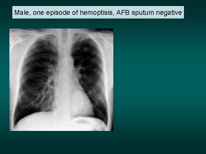 Male, one episode of hemoptisis, AFB sputum negative 