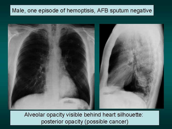 Male, one episode of hemoptisis, AFB sputum negative Alveolar opacity visible behind heart silhouette: