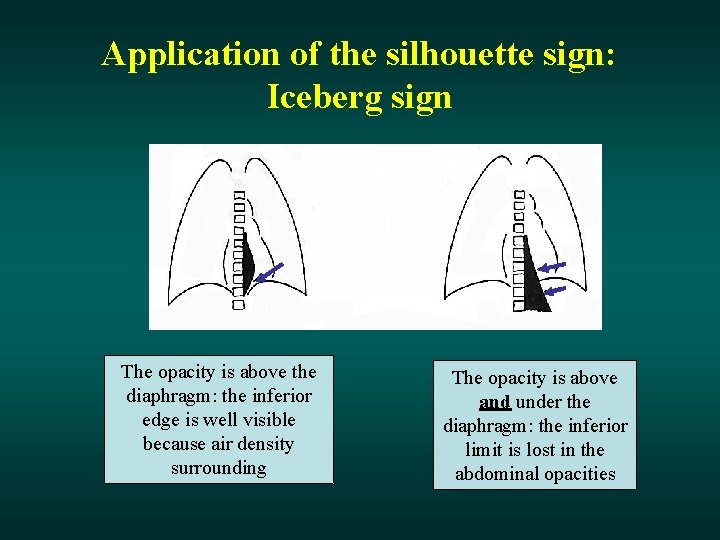 Application of the silhouette sign: Iceberg sign The opacity is above the diaphragm: the