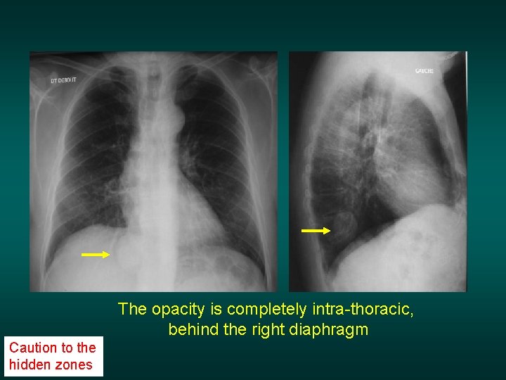 The opacity is completely intra-thoracic, behind the right diaphragm Caution to the hidden zones