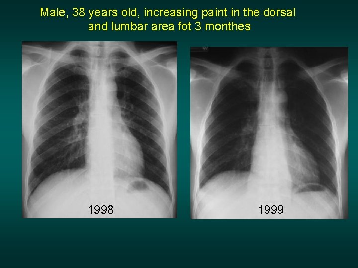 Male, 38 years old, increasing paint in the dorsal and lumbar area fot 3