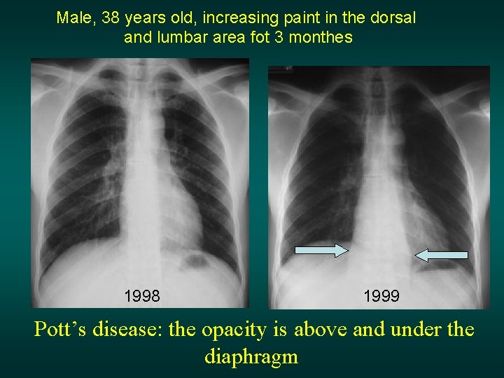 Male, 38 years old, increasing paint in the dorsal and lumbar area fot 3
