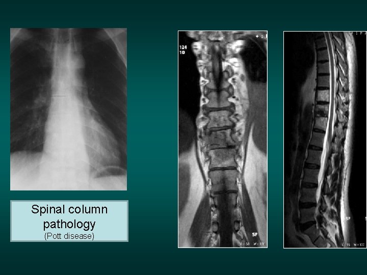 Spinal column pathology (Pott disease) 