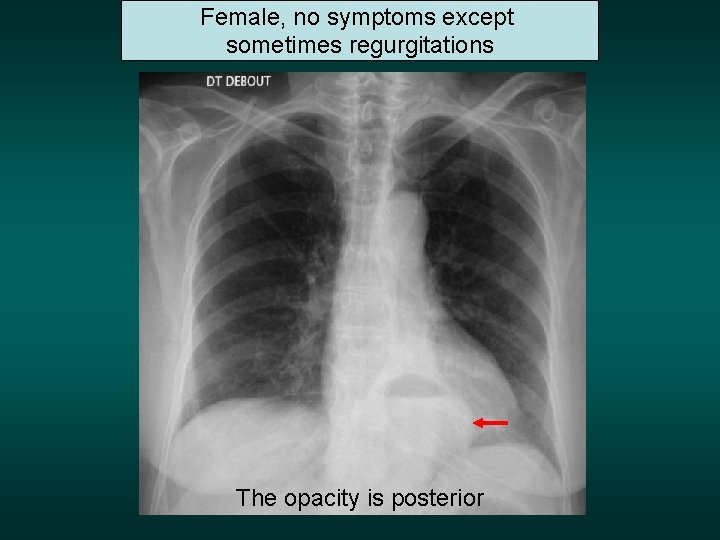 Female, no symptoms except sometimes regurgitations The opacity is posterior 