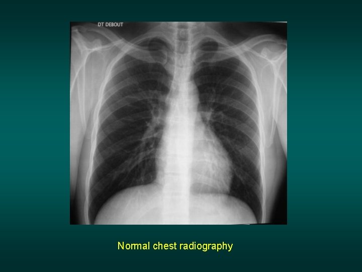 Normal chest radiography 
