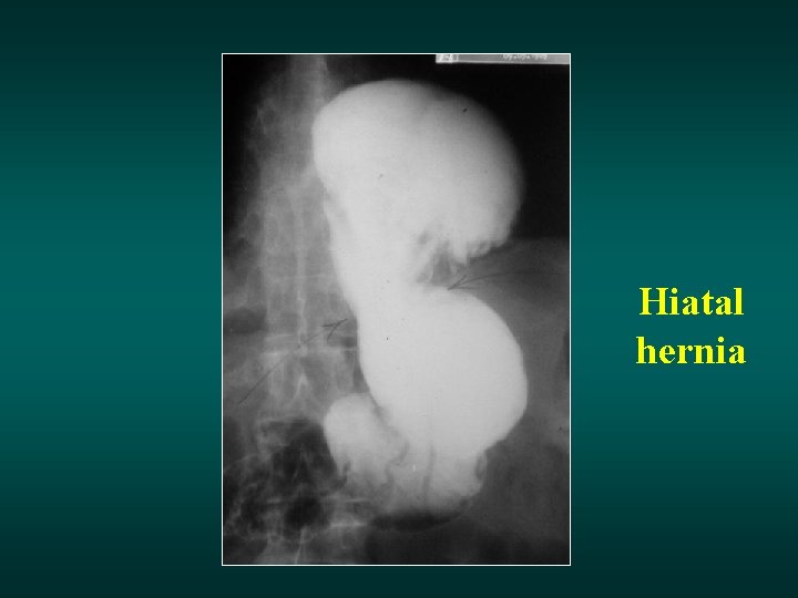 Hiatal hernia 