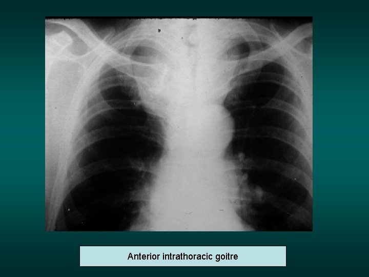 Anterior intrathoracic goitre 