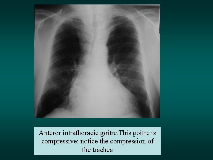 Anteror intrathoracic goitre. This goitre is compressive: notice the compression of the trachea 