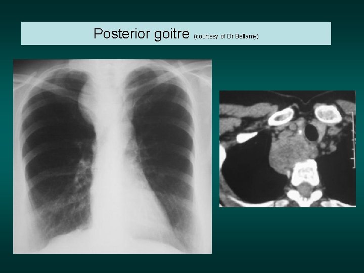Posterior goitre (courtesy of Dr Bellamy) 