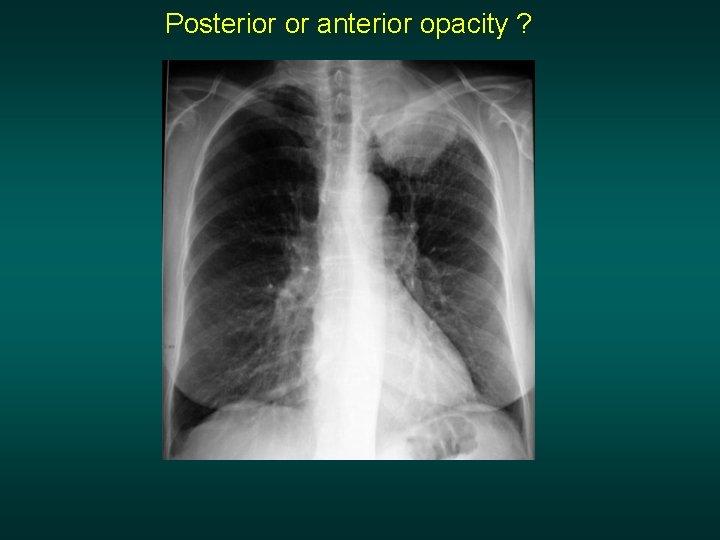 Posterior or anterior opacity ? 