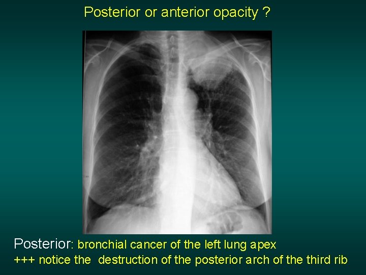 Posterior or anterior opacity ? Posterior: bronchial cancer of the left lung apex +++